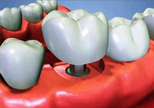 precio de implantes dentales